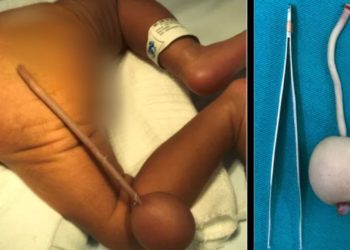 Em Fortaleza-CE, bebê nasce com ‘cauda’ de 12 centímetros e bola na extremidade