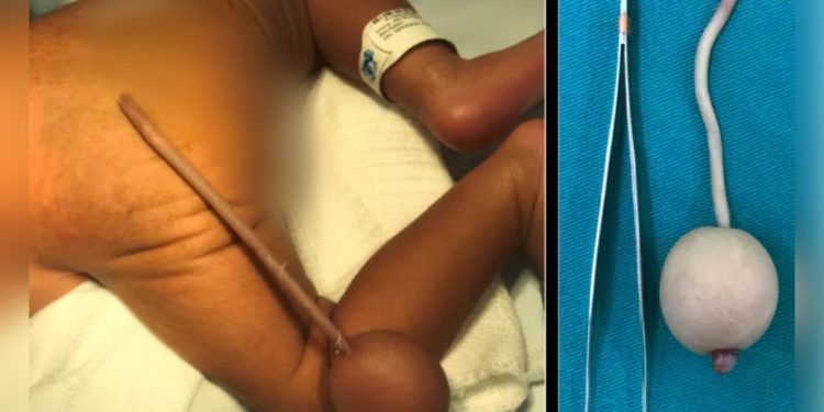 Em Fortaleza-CE, bebê nasce com ‘cauda’ de 12 centímetros e bola na extremidade