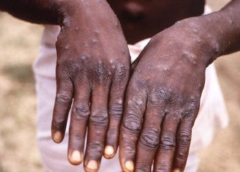 Brasil registra 978 casos de varíola dos macacos