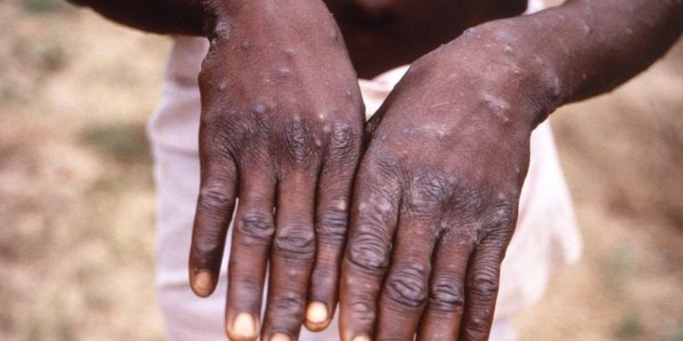 Brasil registra 978 casos de varíola dos macacos