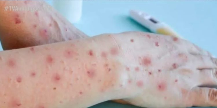 Alerta: Amazonas confirma transmissão local em estado avançado da varíola dos macacos