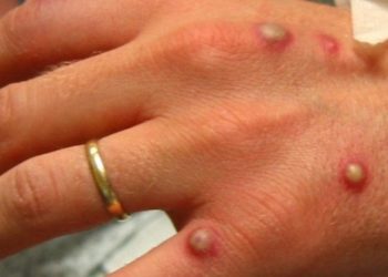 Brasil terá antiviral para tratar varíola dos macacos, diz ministro da saúde 